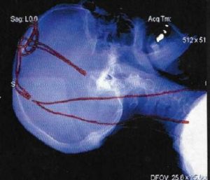 Stimulation Profonde du Cerveau